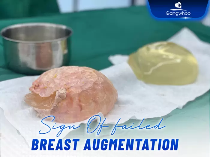 BREAST REVISION – RESCUE YOUR BEAUTY WITH KOREAN TECHNOLOGY AT GANGWHOO HOSPITAL