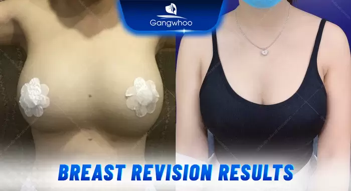 BREAST REVISION – RESCUE YOUR BEAUTY WITH KOREAN TECHNOLOGY AT GANGWHOO HOSPITAL