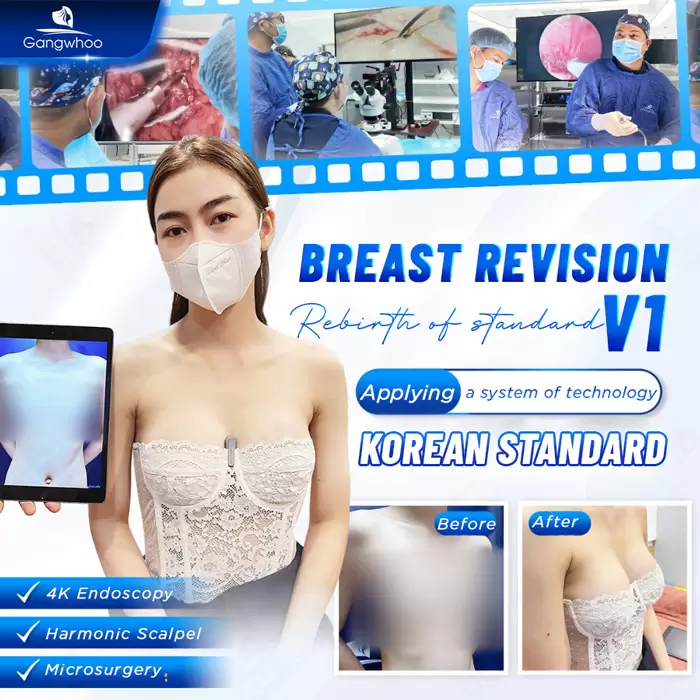BREAST REVISION – RESCUE YOUR BEAUTY WITH KOREAN TECHNOLOGY AT GANGWHOO HOSPITAL