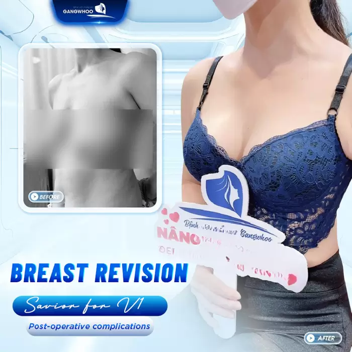 BREAST REVISION – RESCUE YOUR BEAUTY WITH KOREAN TECHNOLOGY AT GANGWHOO HOSPITAL
