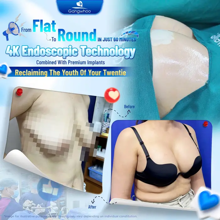 BREAST LIFT OR BREAST AUGMENTATION: WHICH ONE IS BEST-FITTED FOR YOUR BEAUTY