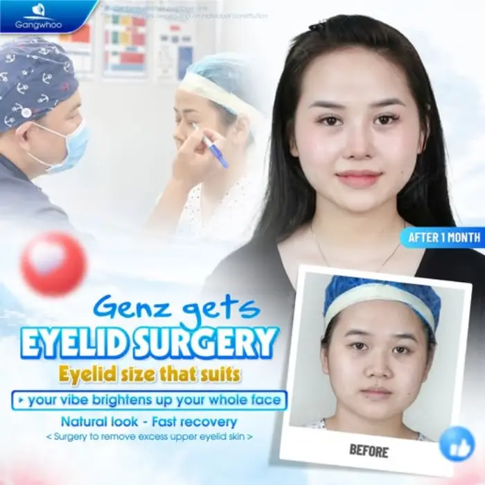 BLEPHAROPLASTY RECOVERY – HOW LONG IT TAKES TO HAVE THE PERFECT EYELIDS?