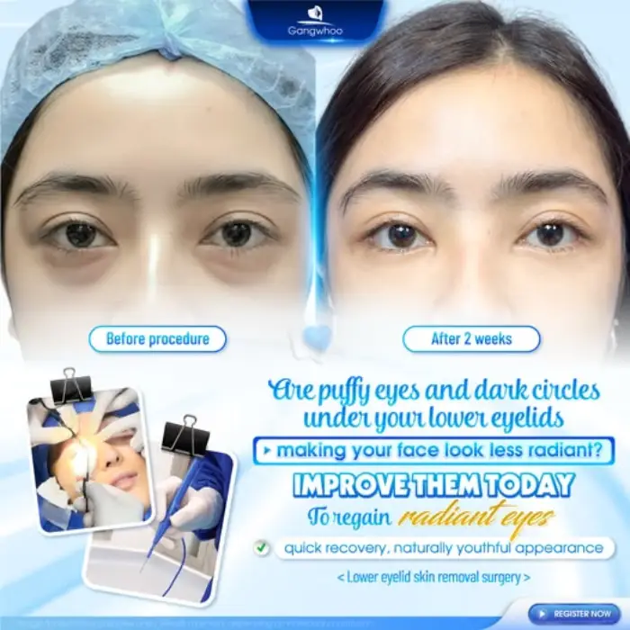 LOWER BLEPHAROPLASTY – HOW PAINFUL AND IS IT WORTH IT?
