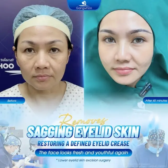 LOWER BLEPHAROPLASTY – HOW PAINFUL AND IS IT WORTH IT?
