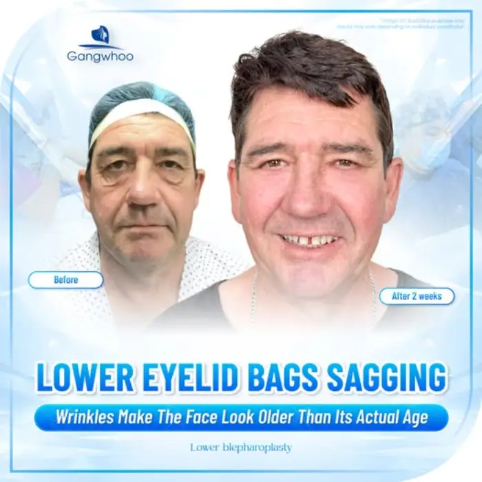 LOWER BLEPHAROPLASTY – HOW PAINFUL AND IS IT WORTH IT?