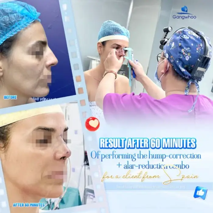 RHINOPLASTY AT GANGWHOO HOSPITAL – WHERE LOVE AND LUCK GO SIDE BY SIDE