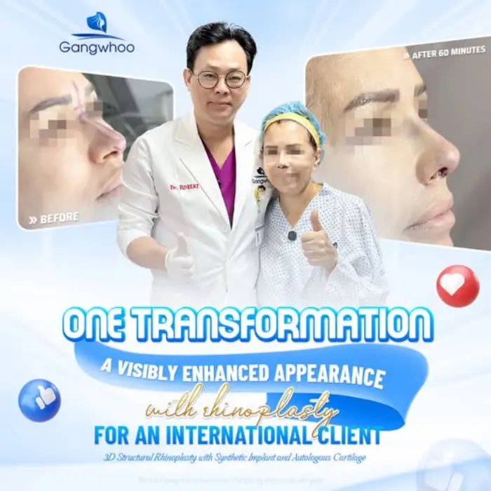 RHINOPLASTY AT GANGWHOO HOSPITAL – WHERE LOVE AND LUCK GO SIDE BY SIDE