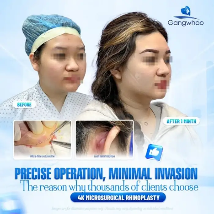 RHINOPLASTY RESULTS – HOW LONG DOES IT TAKE TO ARCHIVE YOUR DESIRED ONE?