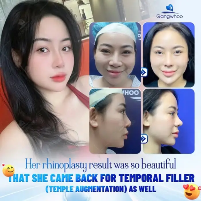 RHINOPLASTY RESULTS – HOW LONG DOES IT TAKE TO ARCHIVE YOUR DESIRED ONE?