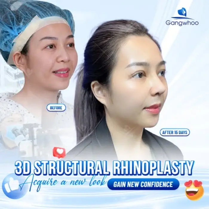 RHINOPLASTY RESULTS – HOW LONG DOES IT TAKE TO ARCHIVE YOUR DESIRED ONE?