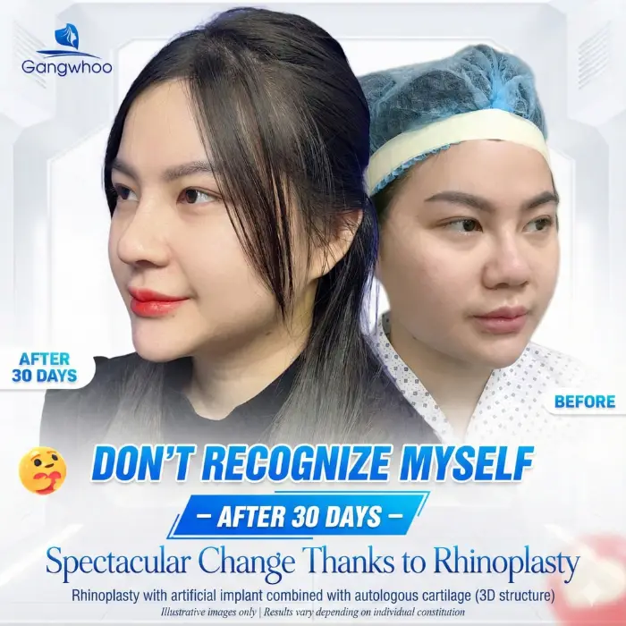 RHINOPLASTY RESULTS – HOW LONG DOES IT TAKE TO ARCHIVE YOUR DESIRED ONE?