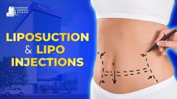 LIPOSUCTION AND LIPO INJECTIONS: 4 BASIC DIFFERENCES AND WHAT BENEFITS ...