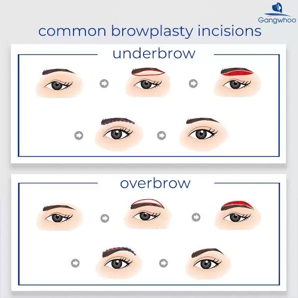 Endoscopic Browplasty – Chasing Away Signs Of “Aging”