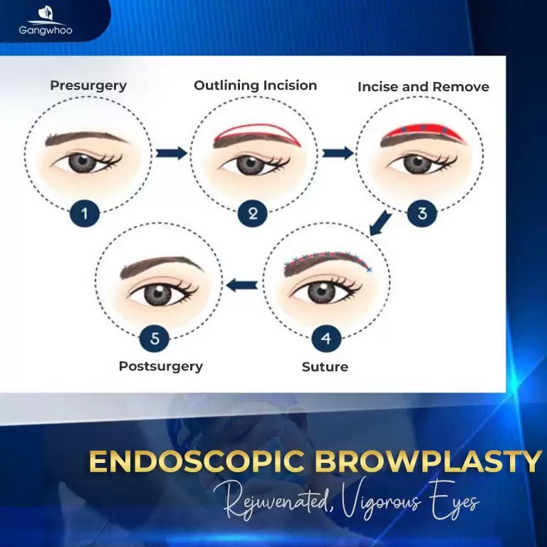 Endoscopic Browplasty – Chasing Away Signs Of “Aging”