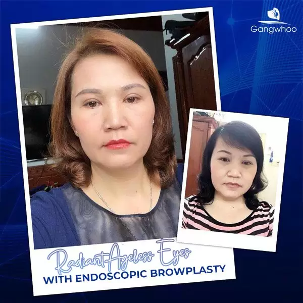 Endoscopic Browplasty – Chasing Away Signs Of “Aging”