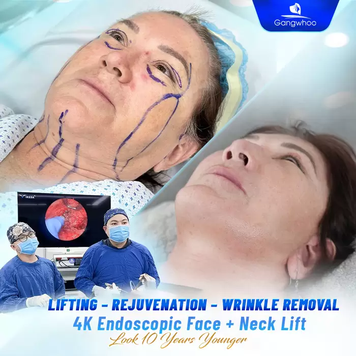 Necklift – A Great Way to Get Rid of Neck Wrinkles