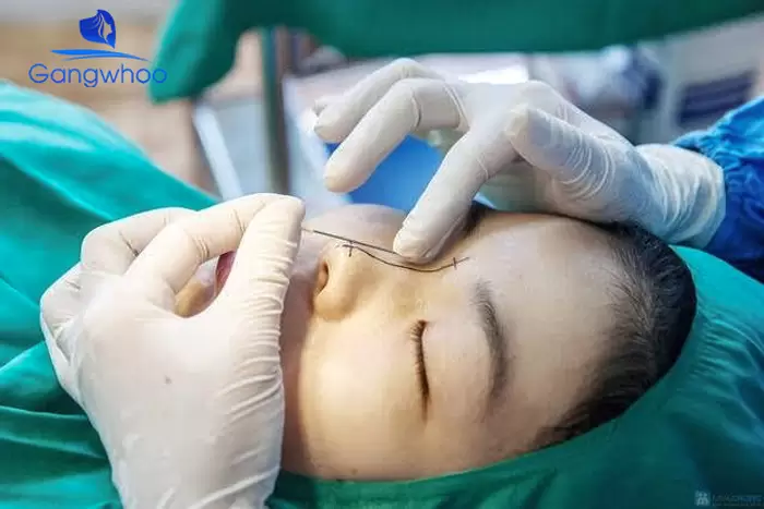 What Exactly Is a Nose Thread Lift? Should You Have This Procedure?