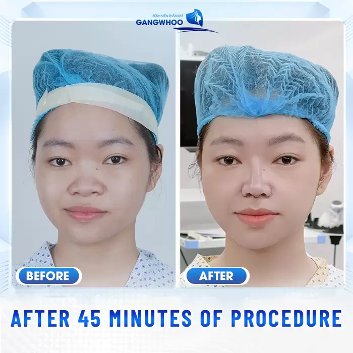What Exactly Is a Nose Thread Lift? Should You Have This Procedure?