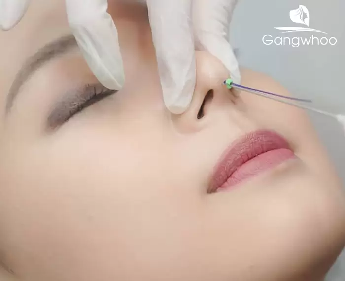 What Exactly Is a Nose Thread Lift? Should You Have This Procedure?