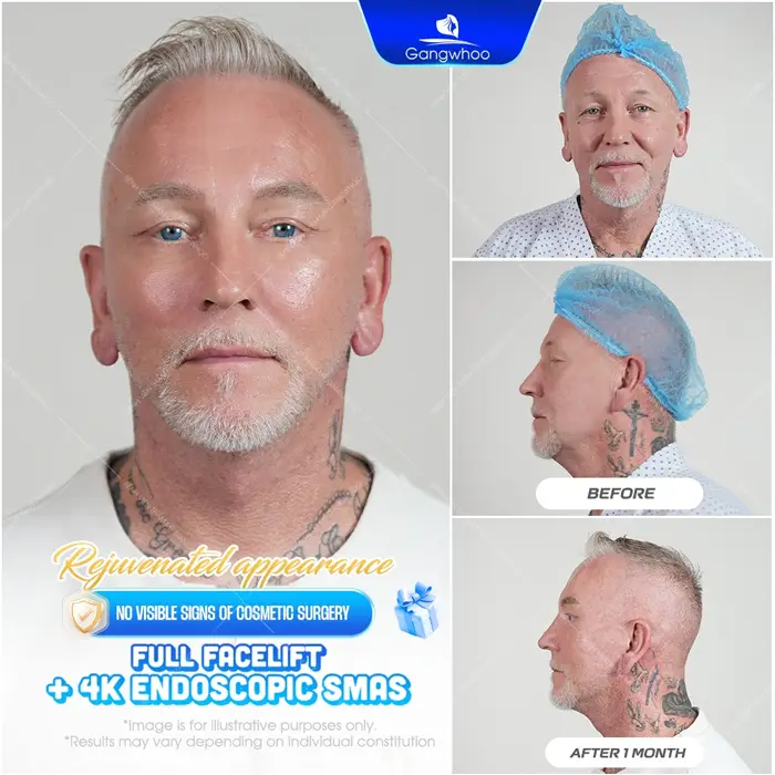 Gangwhoo – Prestigious Facelift Hospital For Overseas Vietnamese