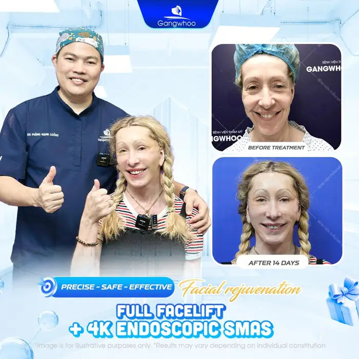 Gangwhoo – Prestigious Facelift Hospital For Overseas Vietnamese