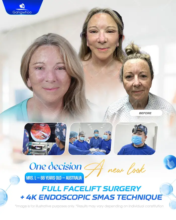 Gangwhoo – Prestigious Facelift Hospital For Overseas Vietnamese