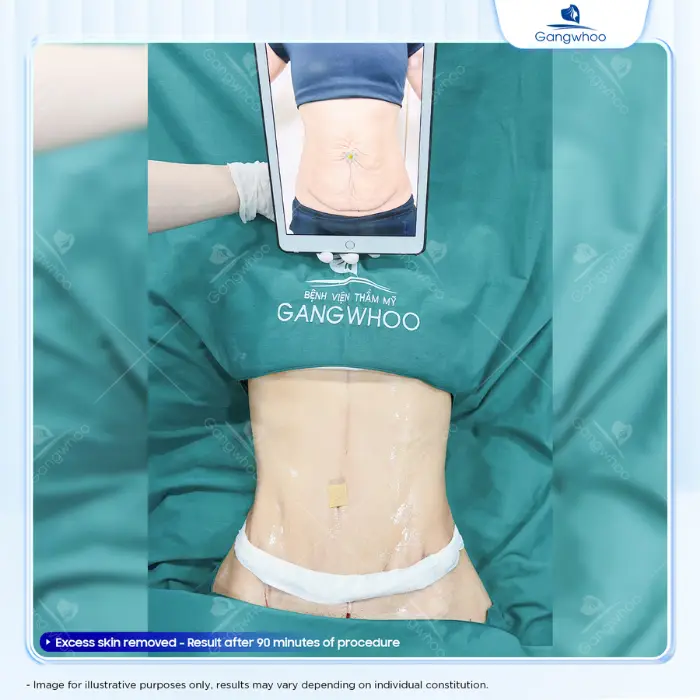Fat Reduction using Ultra Slim – The World’s Number One Healthy Fat Removal Technique in the United States