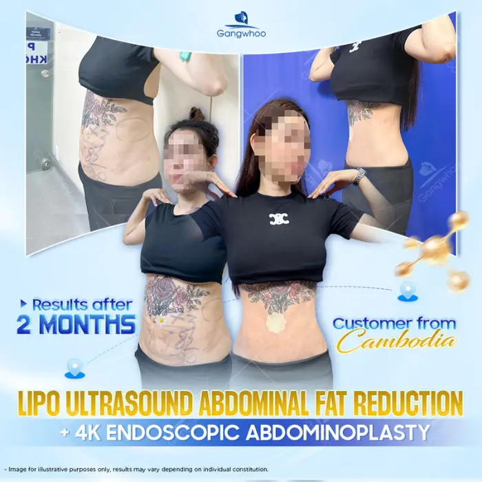 Fat Reduction using Ultra Slim – The World’s Number One Healthy Fat Removal Technique in the United States