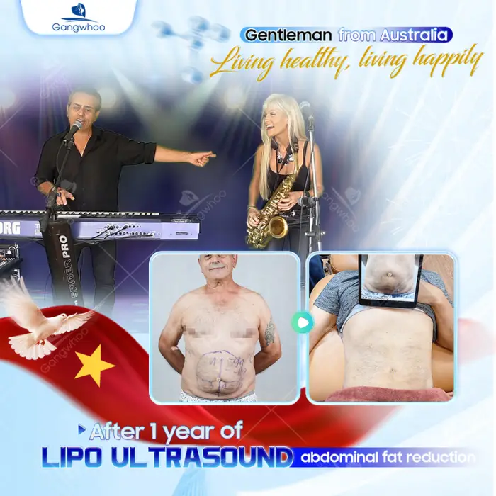 Fat Reduction using Ultra Slim – The World’s Number One Healthy Fat Removal Technique in the United States