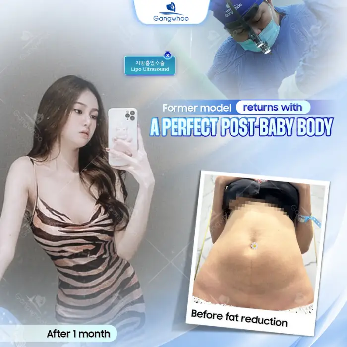 Fat Reduction using Ultra Slim – The World’s Number One Healthy Fat Removal Technique in the United States