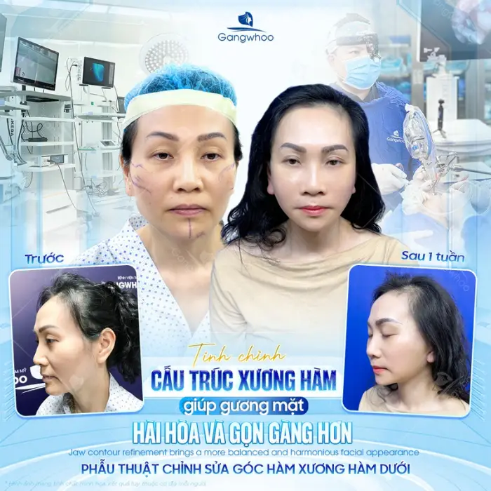 V-Line Mandible Trim – Provides a Slimmer Jawline