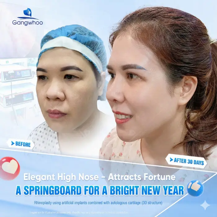 Zose Line Rhinoplasty – GenZ Rhinoplasty Is Beautiful