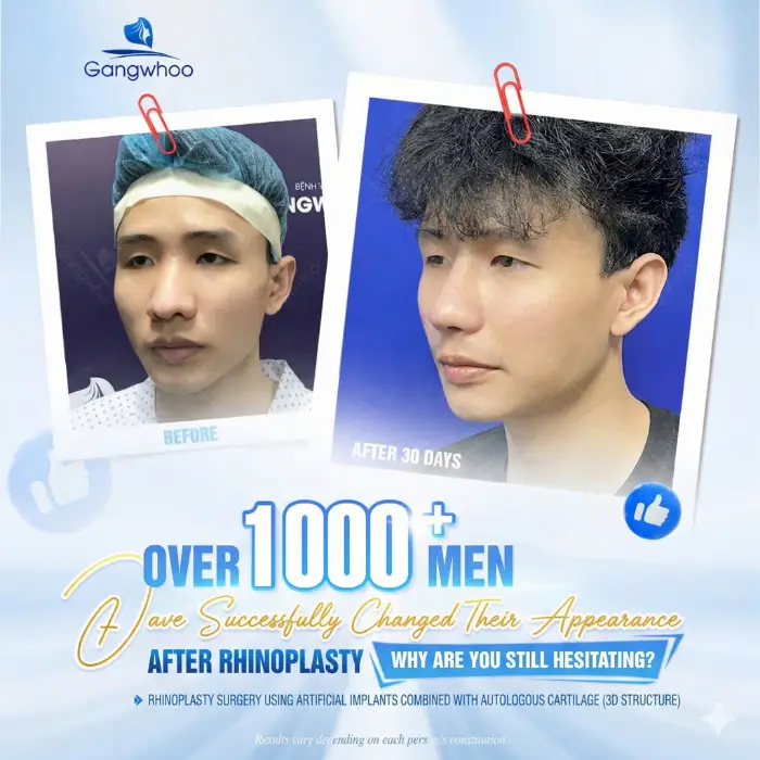 Zose Line Rhinoplasty – GenZ Rhinoplasty Is Beautiful
