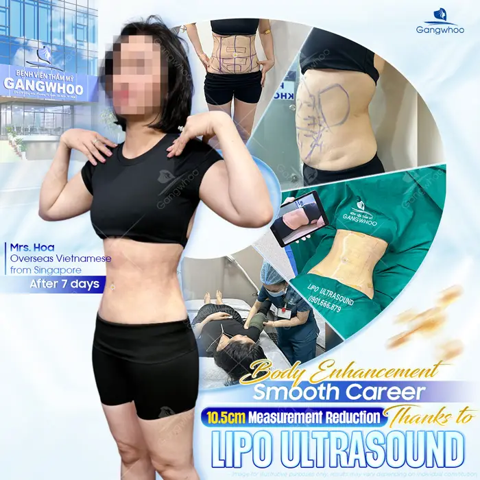 Is Liposuction Safe? – Expert Responses