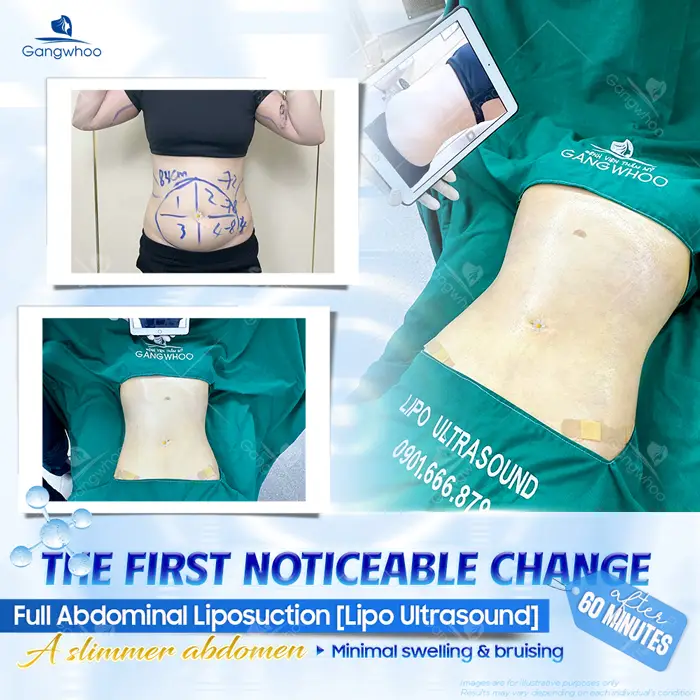 Is Liposuction Safe? – Expert Responses