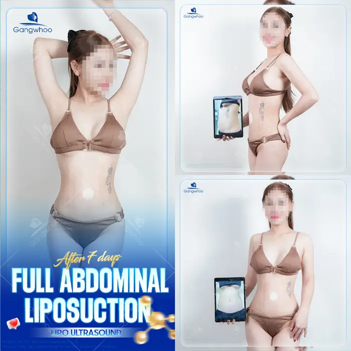 Is Liposuction Safe? – Expert Responses