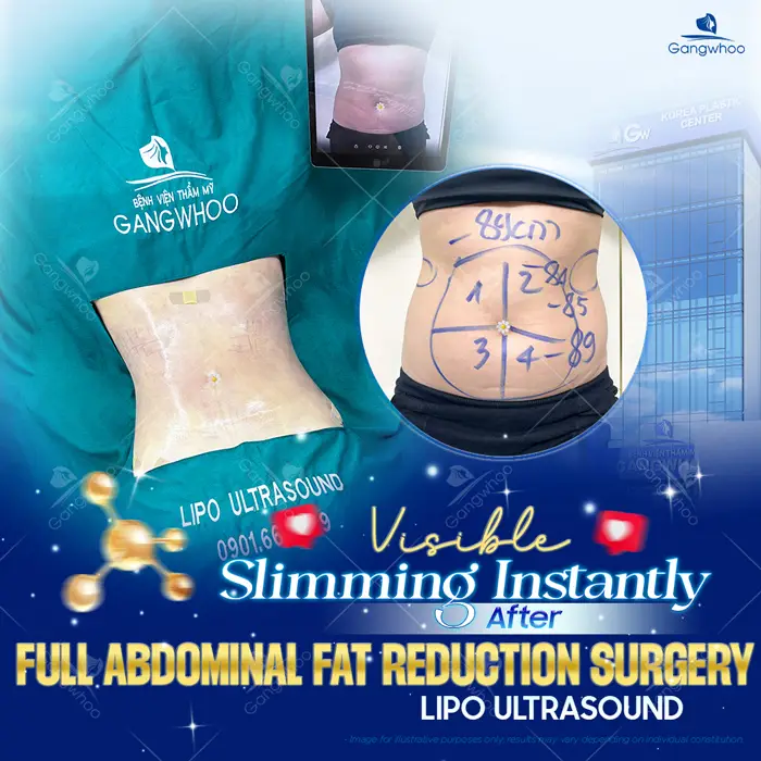 Is Liposuction Safe? – Expert Responses