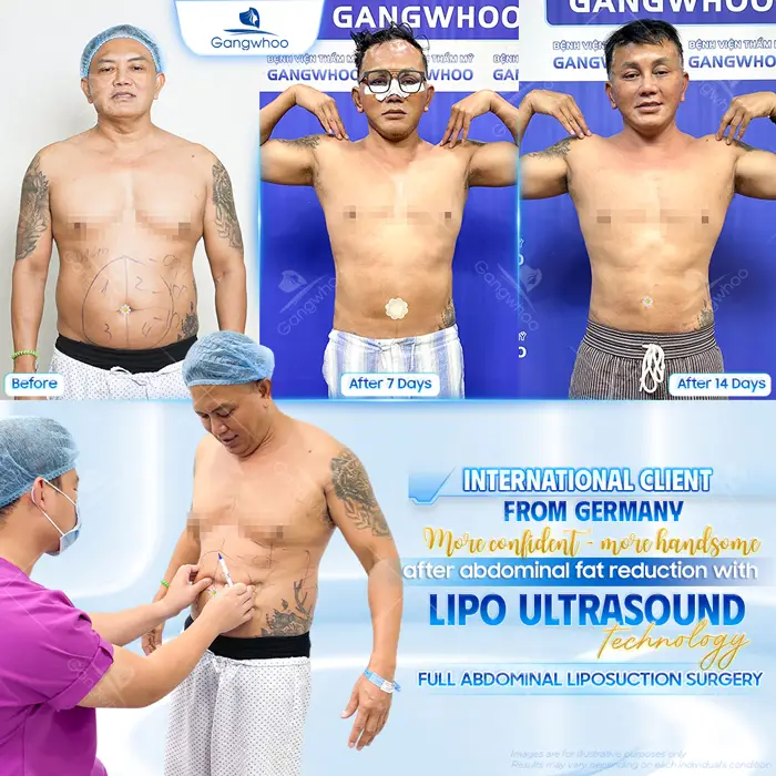 Is Liposuction Safe? – Expert Responses