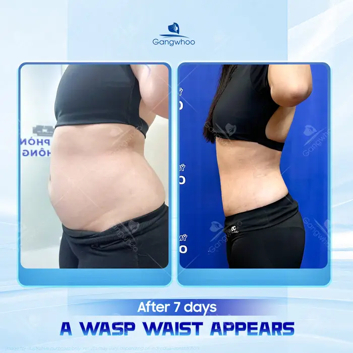 Is Liposuction Safe? – Expert Responses