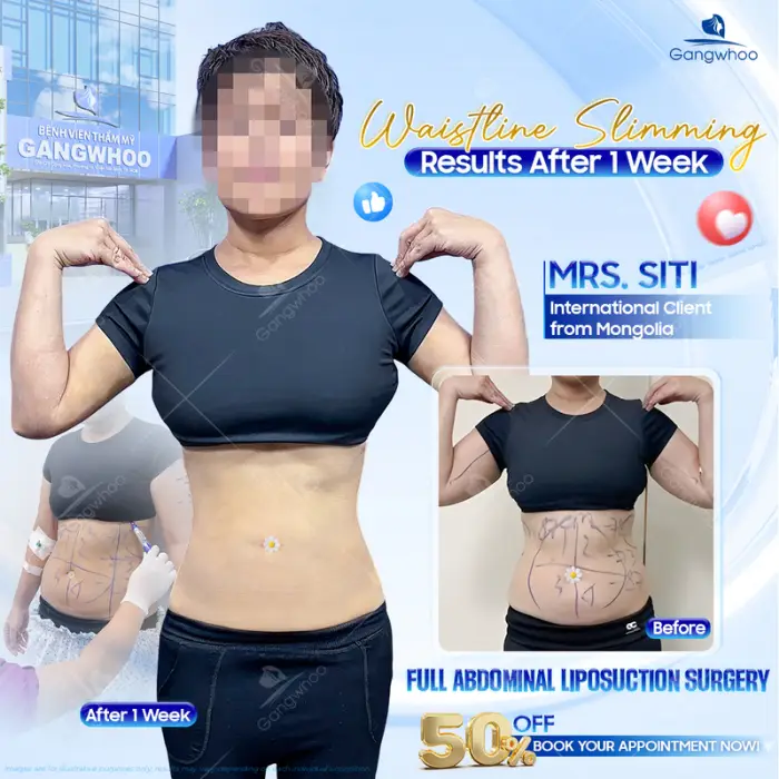 How long should you wait before having sex after having Abdominal Liposuction? 5 methods to look after oneself