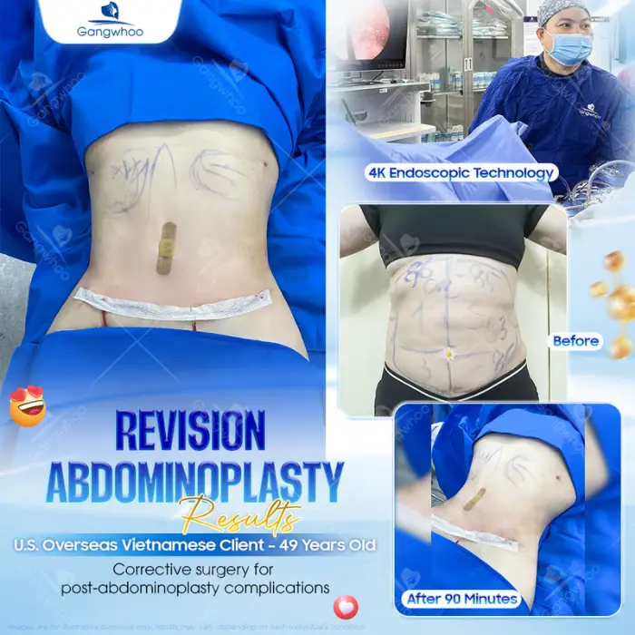 How long should you wait before having sex after having Abdominal Liposuction? 5 methods to look after oneself