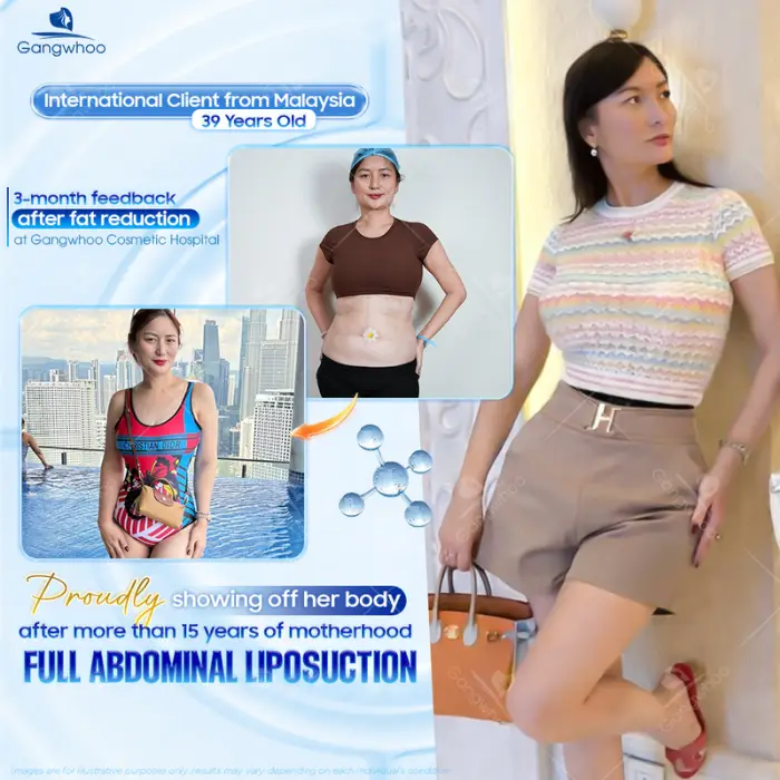 How long should you wait before having sex after having Abdominal Liposuction? 5 methods to look after oneself