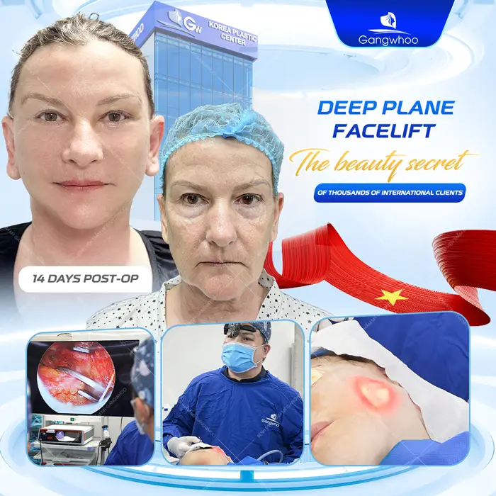 Deep Plane Facelift – The Secret to Safe and Superior Skin Rejuvenation