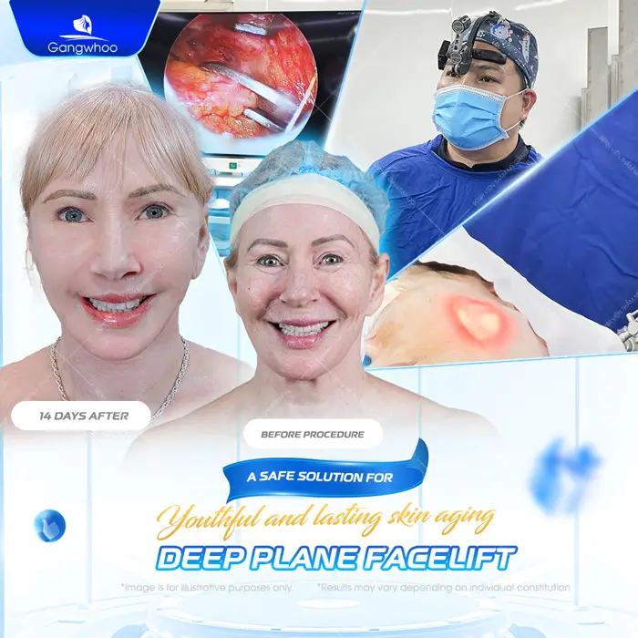 Deep Plane Facelift – The Secret to Safe and Superior Skin Rejuvenation