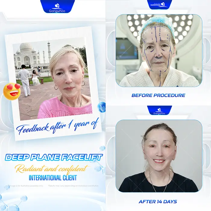 Deep Plane Facelift – The Secret to Safe and Superior Skin Rejuvenation