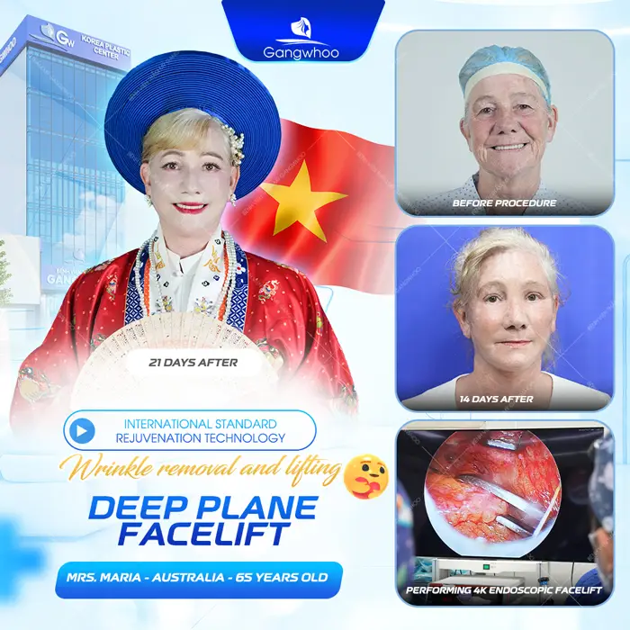Deep Plane Facelift – The Secret to Safe and Superior Skin Rejuvenation