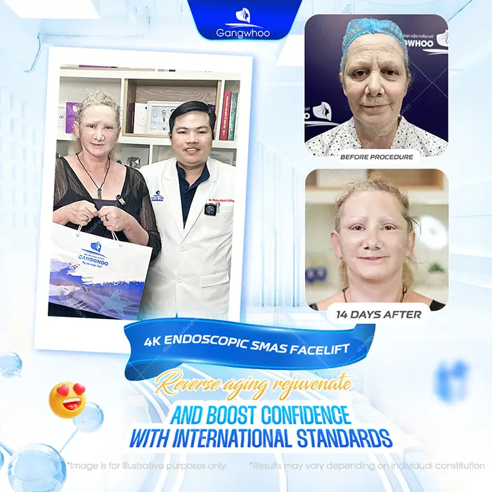 How Long Should You Wear a Facial Compression Band After a Facelift?