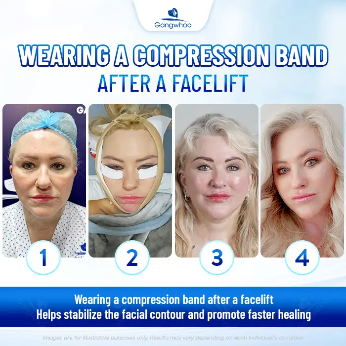 How Long Should You Wear a Facial Compression Band After a Facelift?