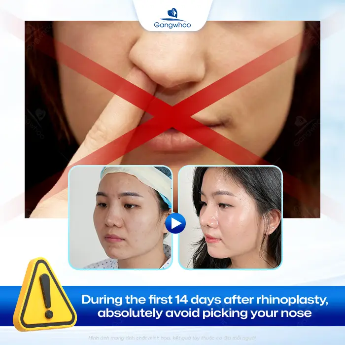 How Long After Rhinoplasty Can You Pick Your Nose? Safe Cleaning Guidelines