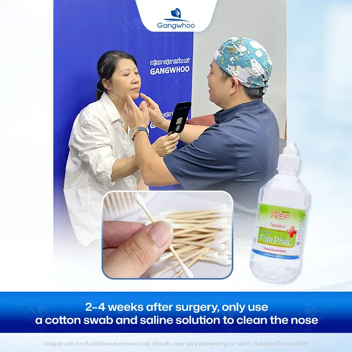 How Long After Rhinoplasty Can You Pick Your Nose? Safe Cleaning Guidelines